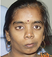 Hemifacial Microsomia 10 Hemifacial Microsomia With Facial Asymmetry, Slanting Smile And Chin Deviation