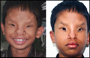 Craniofacial Deformities 17 Hypertelorism - After Surgery