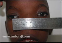 Craniofacial Deformities 21 Before Surgery