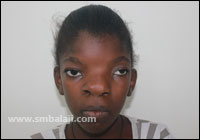 Craniofacial Deformities 20 Orbital Hypertelorism Before Surgery