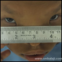 Craniofacial Deformities 8 Increased Distance Between The Eyes (50Mm While Normal Is 35 Mm)