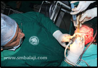 Craniofacial Deformities 22 During Surgery