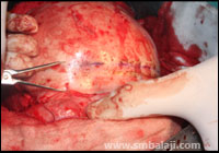 Craniofacial Deformities 9 Skull Bone Exposed, Measurements Marked