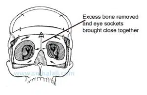 Excess Bone Removed And Eye Sockets Brought Close Together -Hypertelorism