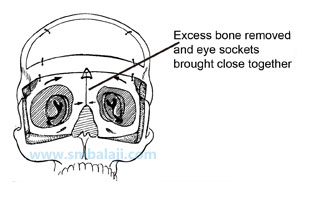 Excess Bone Removed And Eye Sockets Brought Close Together -Hypertelorism