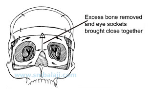 Craniofacial Deformities 2 Excess Bone Removed And Eye Sockets Brought Close Together -Hypertelorism
