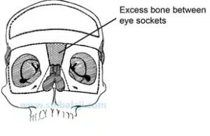 Craniofacial Deformities
