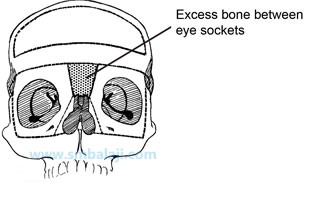 Excess Bone Between Eye Sockets -Hypertelorism