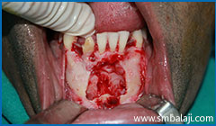 Immediately After Surgical Removal Of Impacted Lower Canine Teeth