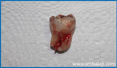 Impacted Wisdom Tooth Surgically Removed Atraumatically