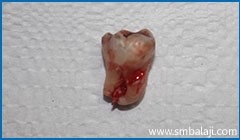 Transalveolar Extraction 5 Impacted Wisdom Tooth Surgically Removed Atraumatically