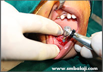 Tumor 12 Implants Being Placed In The Lower Jaw