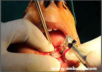 Tumor 13 Implants Being Placed In The Lower Jaw
