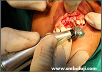 Tumor 14 Implants Placed In The Upper Jaw