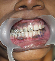 Hemifacial Microsomia 12 Improper Bile Due To Hemifacial Microsomia