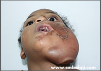 Trauma 4 Inflating The Device Stretches The Skin And New Tissue Is Grown