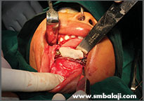 Tumor 6 Jaw Reconstruction Using Bone Graft And Rhbmp-2