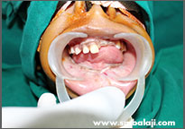Tumor 11 Lower Jaw Before Placement Of Implants