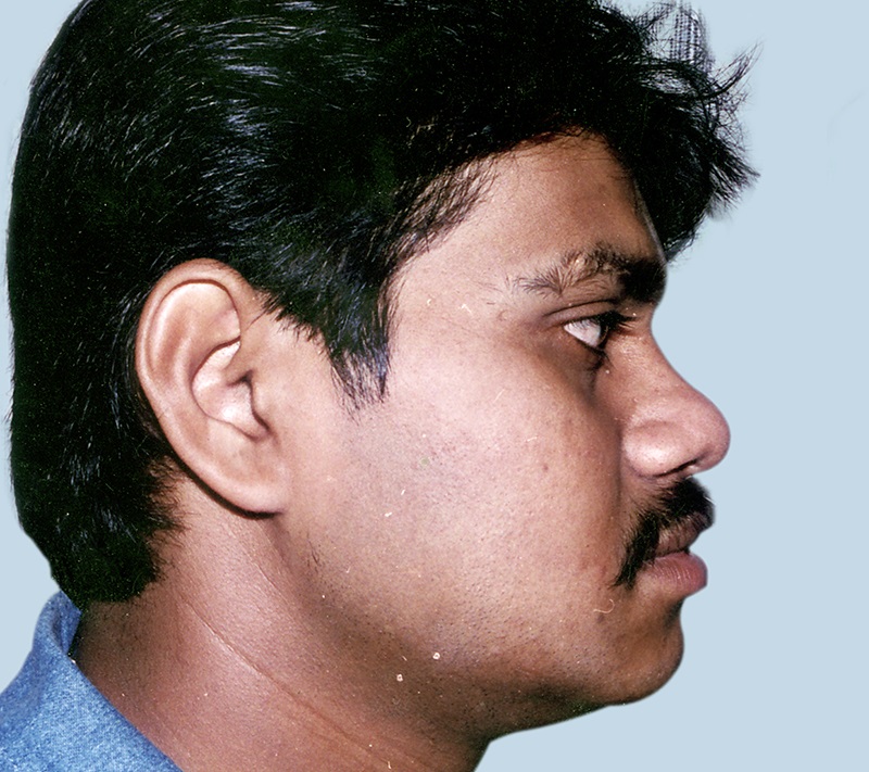 After Surgery Orthognathic Surgery In Idnia