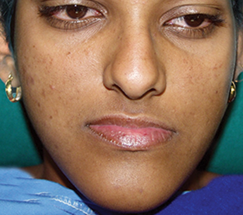Before Surgery Jaw Reconstruction Before Surgery