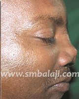 Nose Reconstruction Surgery 2 Nasal Defect Side View Before Treatment