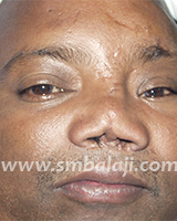 Nose Reconstruction Surgery 1 Nasal Defect Before Treatment