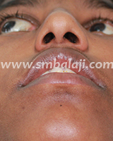 Nose Reconstruction Surgery 12 After Surgery