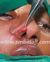 Nose Reconstruction Surgery 11 During Surgery