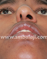 Nose Reconstruction Surgery 10 Nose Deformity