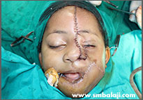 Trauma 6 Nose Reconstructed With Forehead Rotation Flap