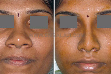 Broad Nose Repair 1 Nose Reduction Surgery Of A Very Broad Nose Chennai India Before After Picture
