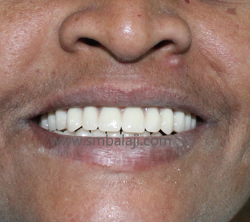 Patient Wearing Complete Removable Dentures