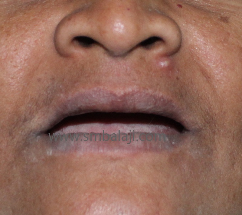 Patient With Complete Tooth Loss