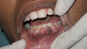 Periodontics/Management Of Gum Diseases