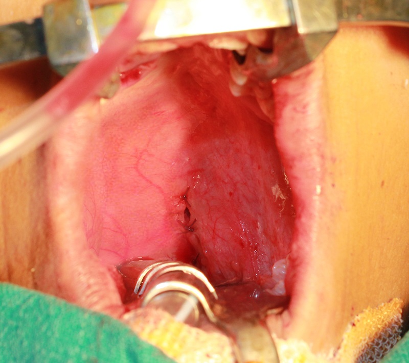 Treatment 10 Pharyngoplasty After Picture