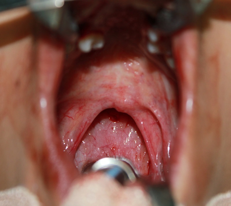 Treatment 9 Pharyngoplasty Before Picture