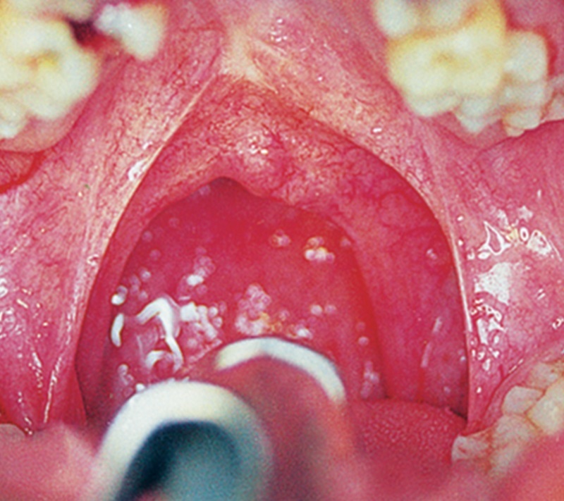 Treatment 11 Pharyngoplasty Surgery Before Picture