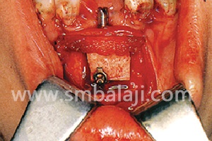 Distraction and Dental Implants 2 Placement Of Alveolar Distraction Device