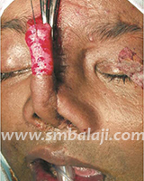 Nose Reconstruction Surgery 3 Placement Of Forehead Flap