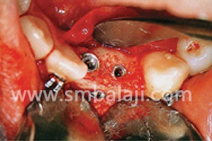 Distraction and Dental Implants 4 Placement Of Implant Screws