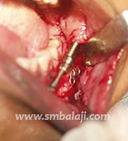 Hemifacial Microsomia 14 Placing The Intraoral Distractor