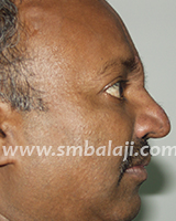 Nose Reconstruction Surgery 6 Post Operative Side View After One Month