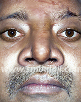 Nose Reconstruction Surgery 5 Post Operative View After One Month