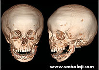 Tumor 7 Postoperative Ct Scan Image