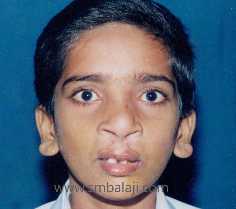 Treatment 14 Premaxillary Set Back After Surgery