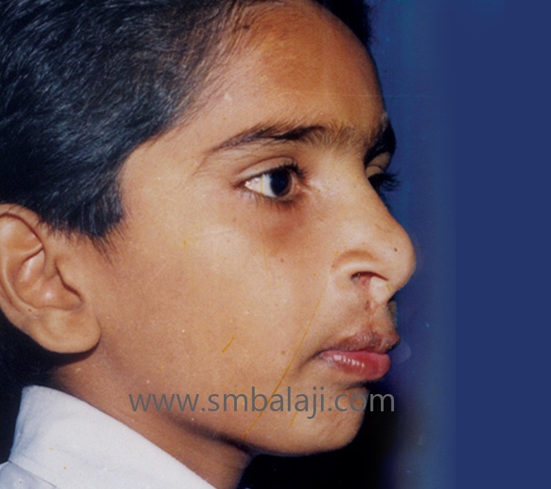 Treatment 16 Premaxillary Set Back After Surgery1 1