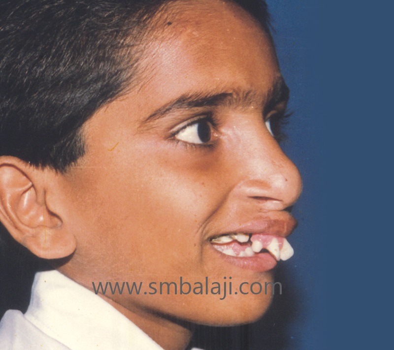 Treatment 15 Premaxillary Set Back Before Surgery1