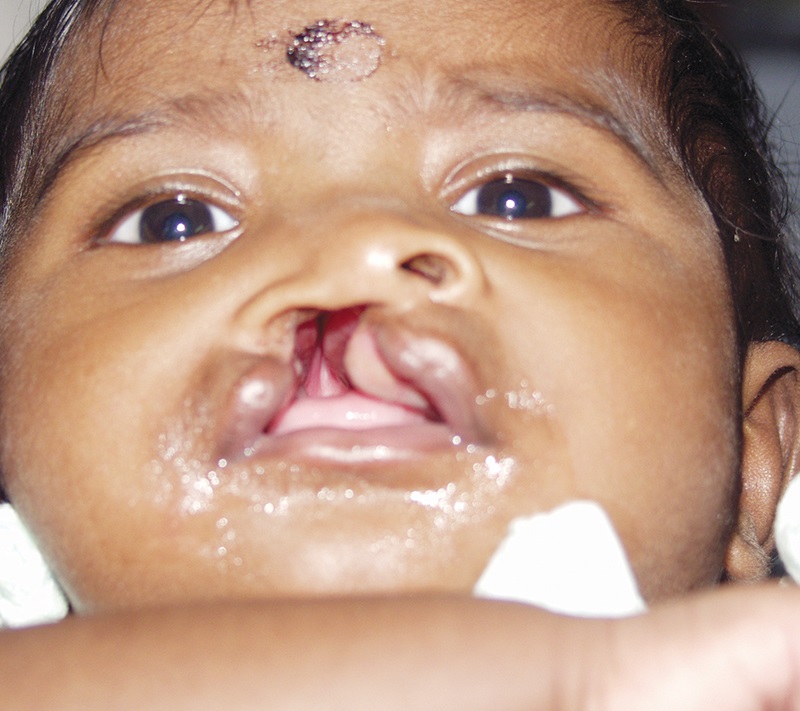 Treatment 1 Primary Lip Repair Before 1