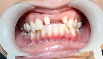 Prosthodontics/ Management Of Missing Teeth