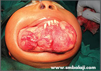 Tumor 5 Removal Of The Tumour From The Lower Jaw